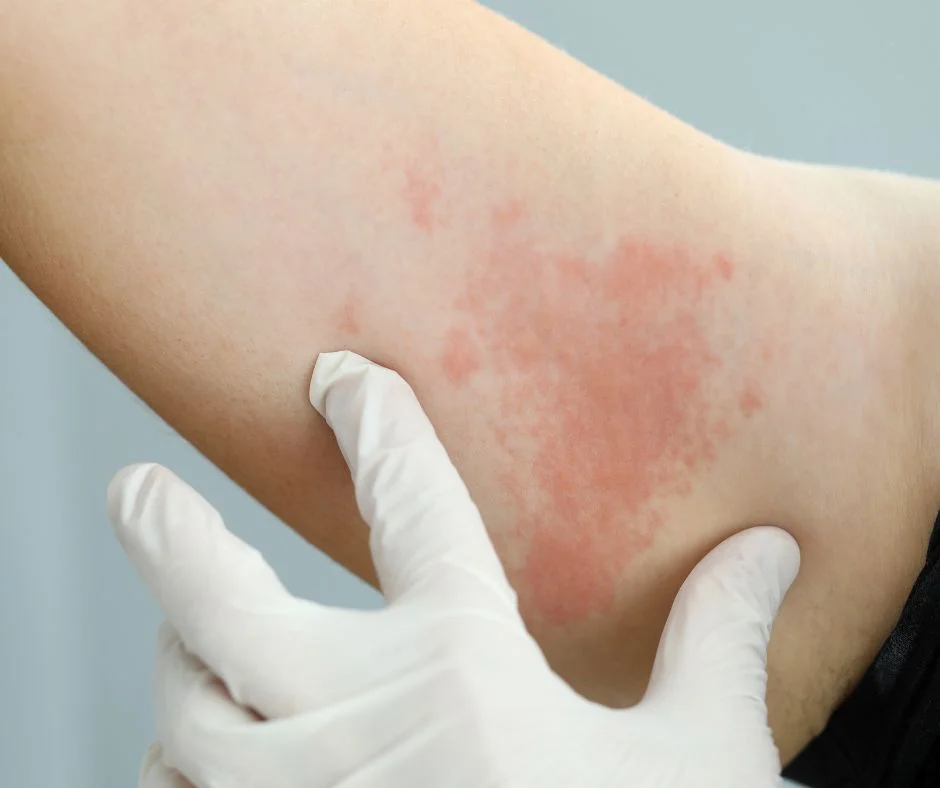 SKIN LESIONS TYPES