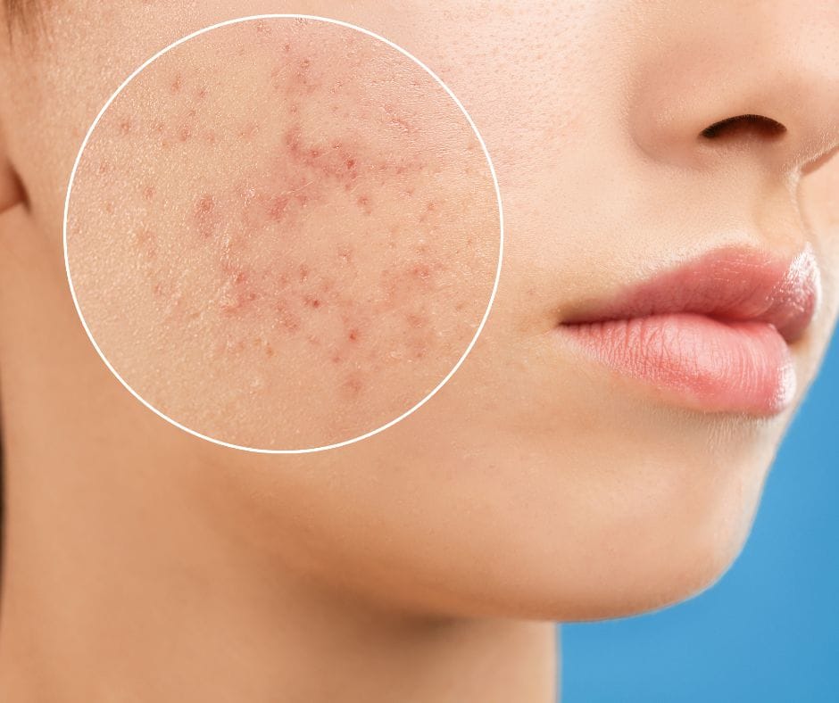 Spironolactone for Acne: Clear Skin Solutions